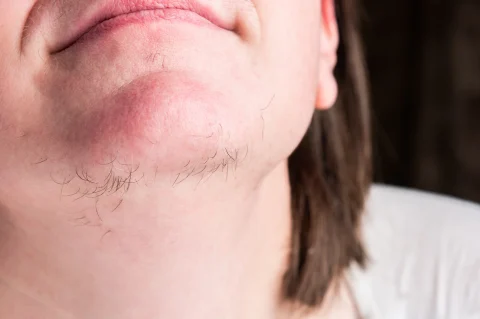 Hirsutism